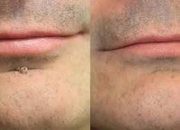 ✨Elmstr®2-in-1 Microneedle & Hydrocolloid Patch🍀| Removes Raised Moles, Acne, Flat Warts & Skin Tags | Helps Improve Wrinkles, Scars & Blemishes | Invisible Patches for Face & Body