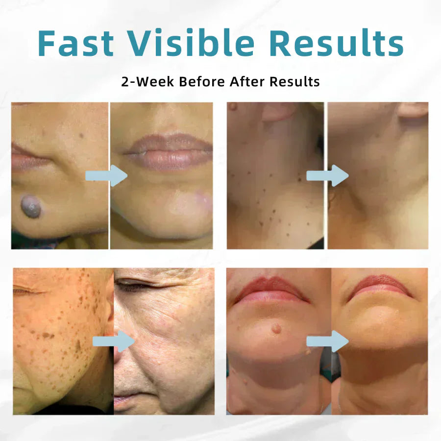 ✨All-in-One CO₂ Laser Eraser Pen | Removes Moles, Warts, Skin Flaws & Pigmentation