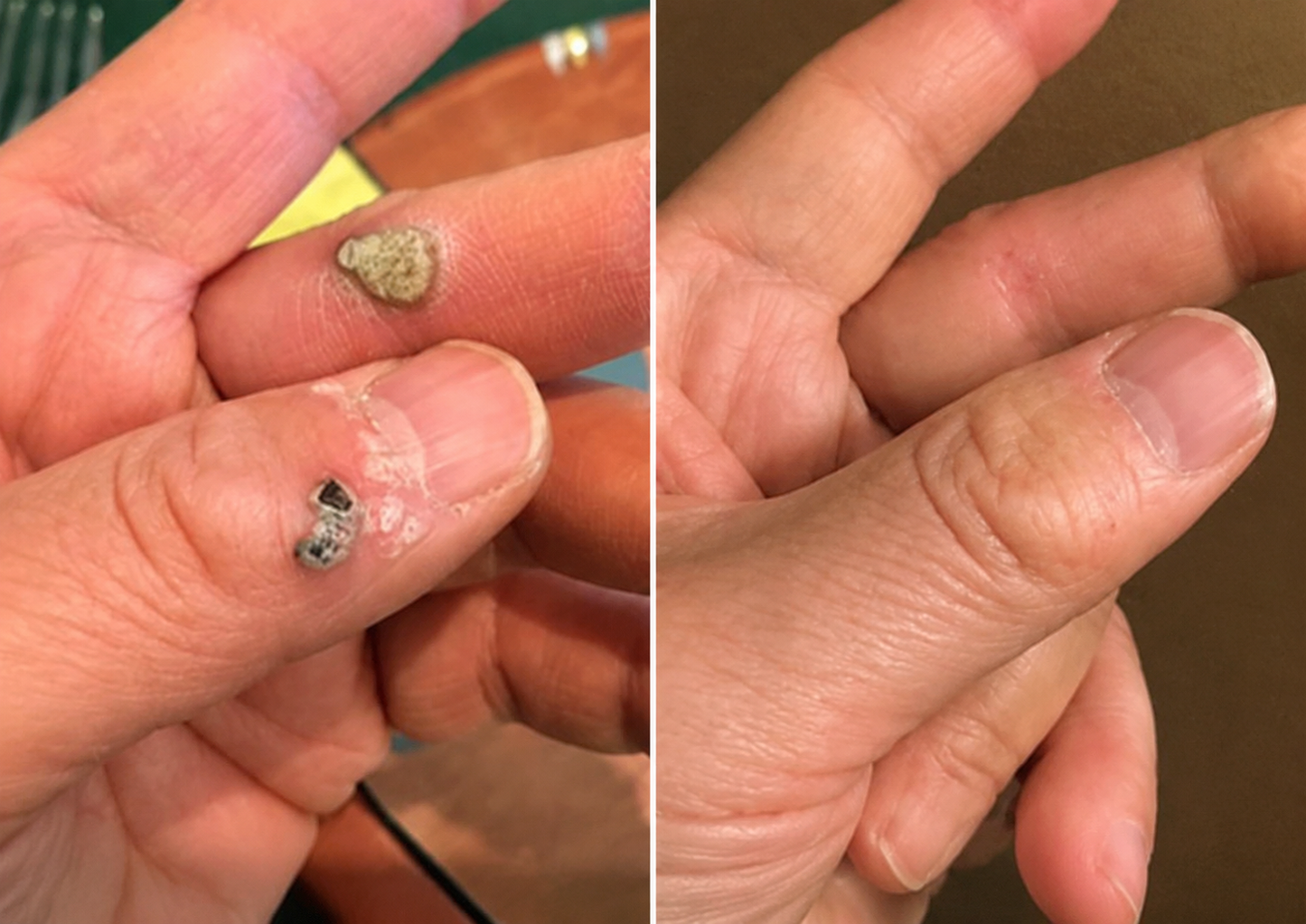 ✨Elmstr®2-in-1 Microneedle & Hydrocolloid Patch🍀| Removes Raised Moles, Acne, Flat Warts & Skin Tags | Helps Improve Wrinkles, Scars & Blemishes | Invisible Patches for Face & Body